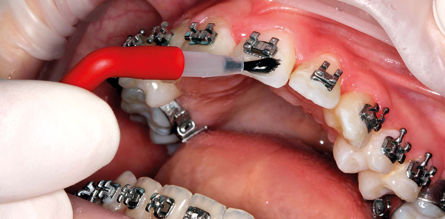 Fluoridhaltiger Lack schützt Zähne mit kieferorthopädischen Brackets