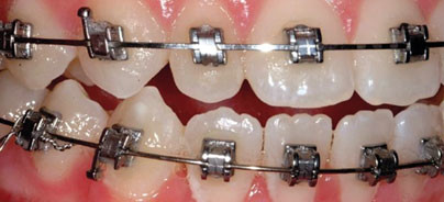 Selbstligierende Brackets – Dichtung und Wahrheit