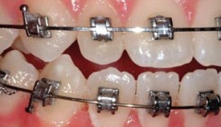 Selbstligierende Brackets – Dichtung und Wahrheit