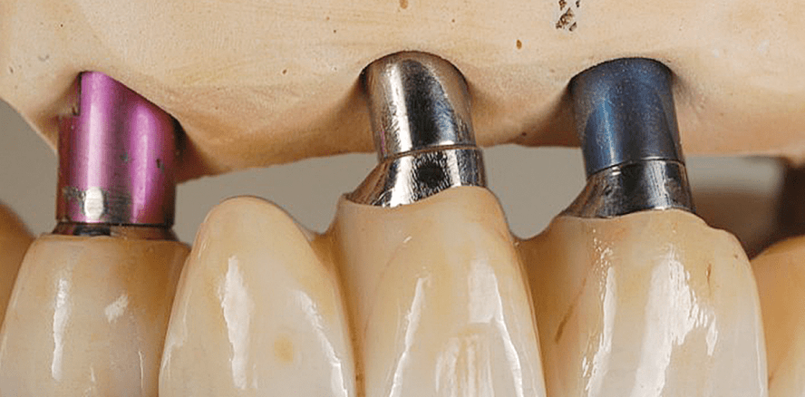 Bedingt herausnehmbare Brücke auf sechs Implantaten