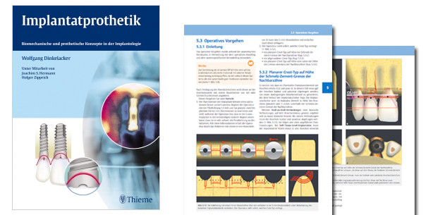 Biomechanische und prothetische Konzepte in der Implantologie