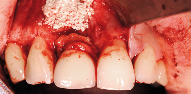 Augmentative Korrektur nach ­Fehlpositionierung in der OK-Front