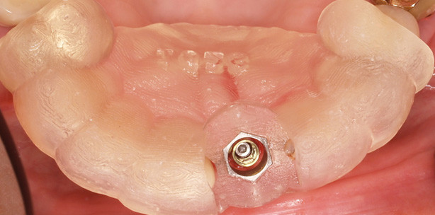 3-D-Planung und navigierte Implantation