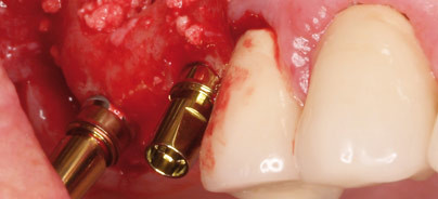 Eigenknochen, bovin oder synthetisch