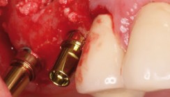 Eigenknochen, bovin oder synthetisch