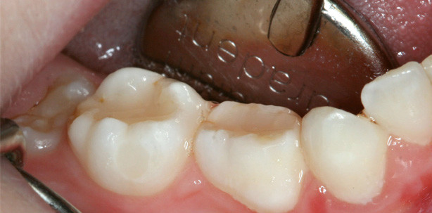 Verwendung eines Bulkfüll-Materials in der Kinderzahnheilkunde