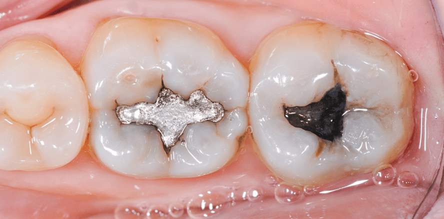 Bulk-Fill-Seitenzahnkomposite: Effizient, ästhetisch, wirtschaftlich