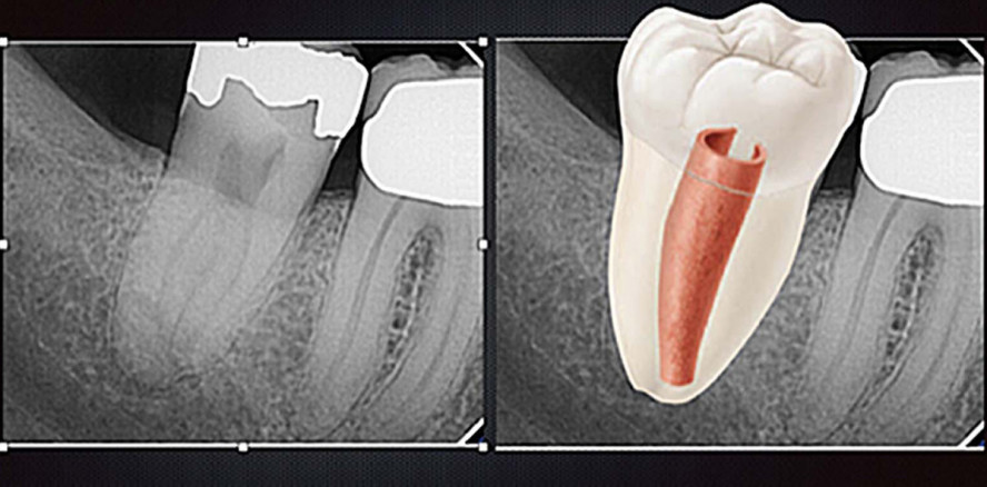 C-förmige Wurzelkanäle – eine endodontische Herausforderung