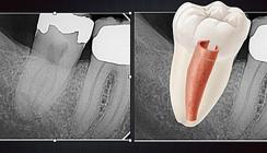 C-förmige Wurzelkanäle – eine endodontische Herausforderung