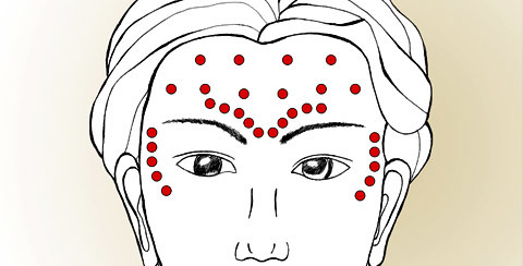 Faltentherapie mit Botulinumtoxin A