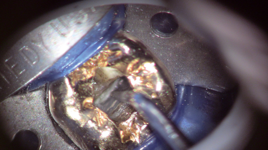 Ultraschall in der Endodontie – effektiv und vielseitig