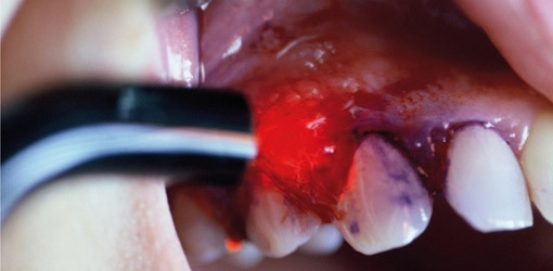 Konsequente Nachsorge: „Laser und Periimplantitis“ im Wochenend-Curriculum