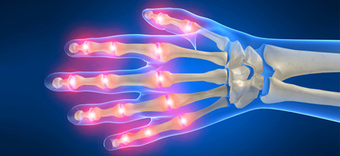 Parodontitis und Arthritis