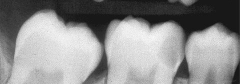 Notfallendodontie im Praxisalltag