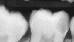 Notfallendodontie im Praxisalltag
