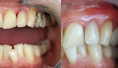 Moderne Prothetik aus Nylon: Ästhetisch und allergiefrei