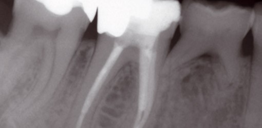 Moderne Endodontie - Ein Überblick