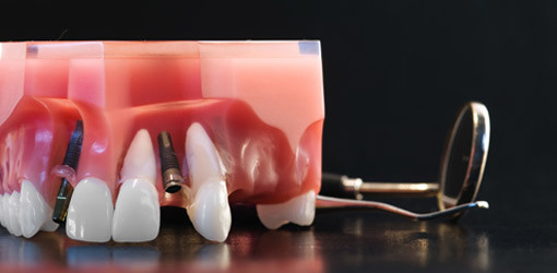 Implantatversorgung bei Nichtanlage von Zähnen?