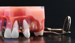 Implantatversorgung bei Nichtanlage von Zähnen?