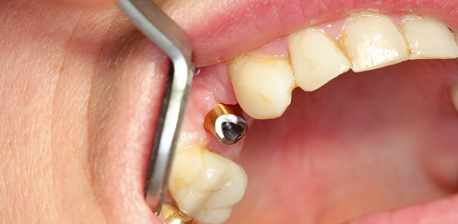 Stabile periimplantäre Gewebe auf Dauer