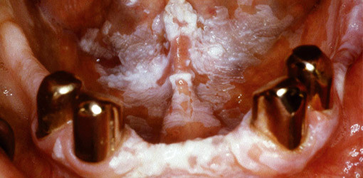 Rolle des Geschlechts bei Mundschleimhauterkrankungen