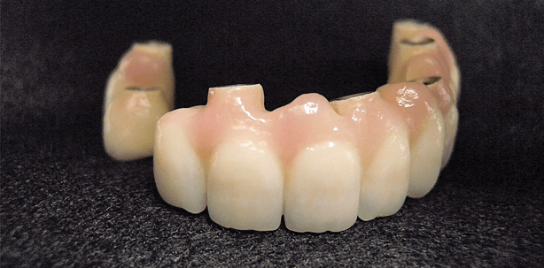 Kombinierte, CAD/CAM-gefertigte Brücken auf sieben Implantaten