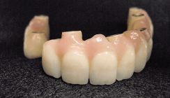 Kombinierte, CAD/CAM-gefertigte Brücken auf sieben Implantaten