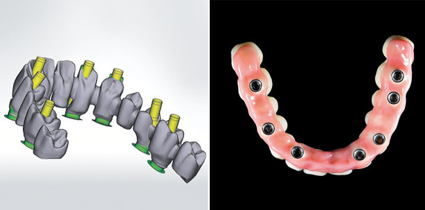 CAD/CAM-gefertigte Brücken im zahnlosen Kiefer