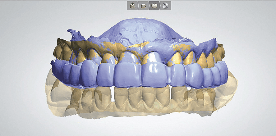 Hybridkeramik: Ein CAD/CAM-Material für Patienten mit Funktionsstörungen?