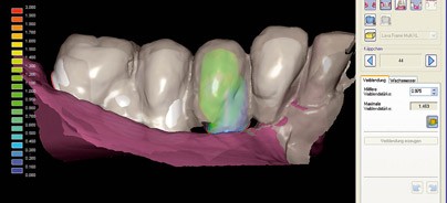 Funktion und Ästhetik – Implantologische Versorgung mittels CAD/CAM