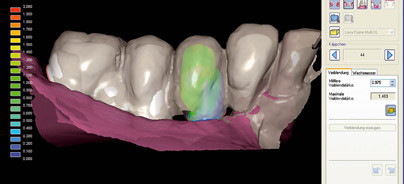 Funktion und Ästhetik – Implantologische Versorgung mittels CAD/CAM