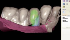 Funktion und Ästhetik – Implantologische Versorgung mittels CAD/CAM