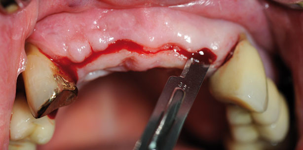 Individuelle CAD/CAM-Abutments und neues Implantatdesign für mehr Ästhetik