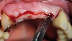 Individuelle CAD/CAM-Abutments und neues Implantatdesign für mehr Ästhetik