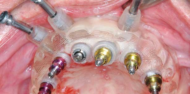 Die computergestützte Implantologie im Alter