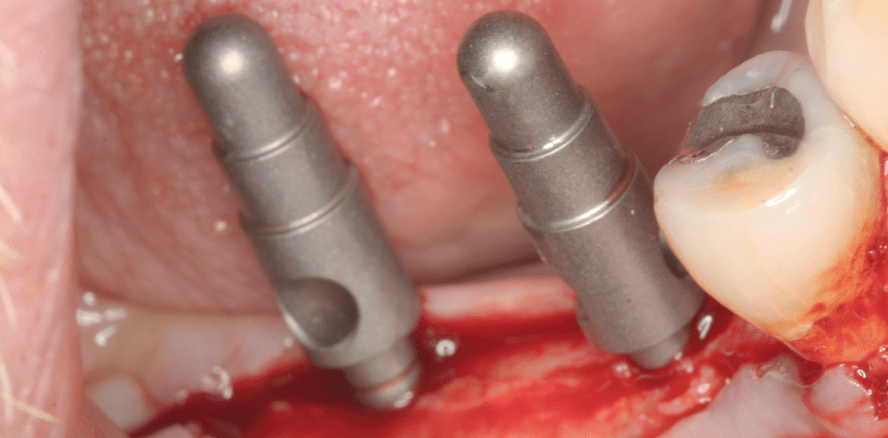 Standardisierte Implantatprothetik mit Konzept