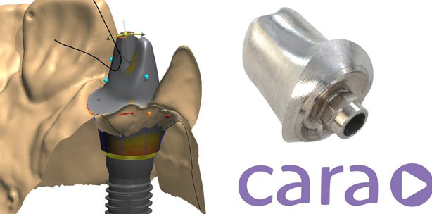 Noch mehr Flexibilität und Individualität in der Implantatprothetik