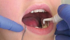 Apparatives Verfahren für die klinische Kariesdiagnostik