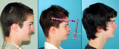 Osteodistraktion in Mittelgesicht und Unterkiefer