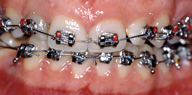 Die kieferorthopädische Behandlung erwachsener Patienten