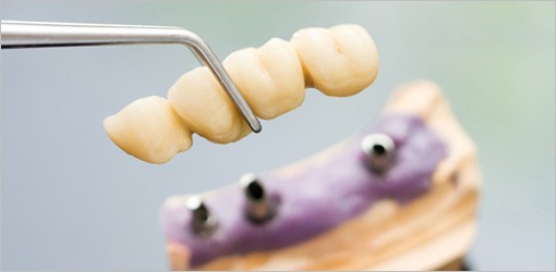 Schluckstörungen durch Zahnprothesen