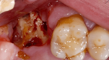 Zahnerhalt vs. Implantation – Ein Konzept