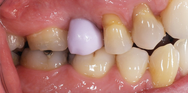 Chairside-Fertigung einer Hybrid-Abutmentkrone