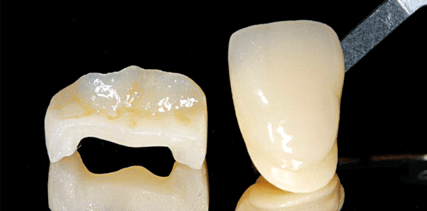 Chairside-Versorgung mit zirkonoxidverstärkter Lithiumsilikatkeramik