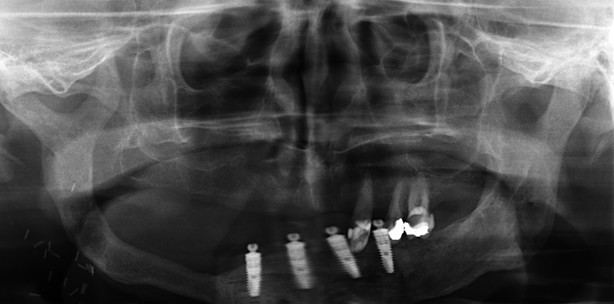Rekonstruktion von Unterkieferdefekten nach Radiochemotherapie