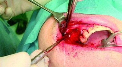 Neue Wege in der Knochenaugmentation