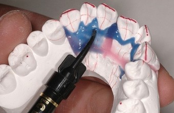 Das CLEAR-ALIGNER-Konzept nach Dr. Kim