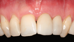 Einteiliges Keramikimplantat im Frontzahnbereich – eine Alternative zu Titan?