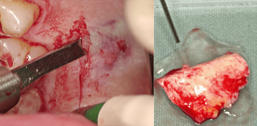 3-D-Augmentation mit simultaner Implantation