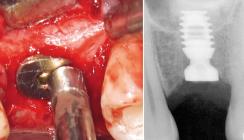 Minimalinvasive Sinusaugmentation mit Kurzimplantaten